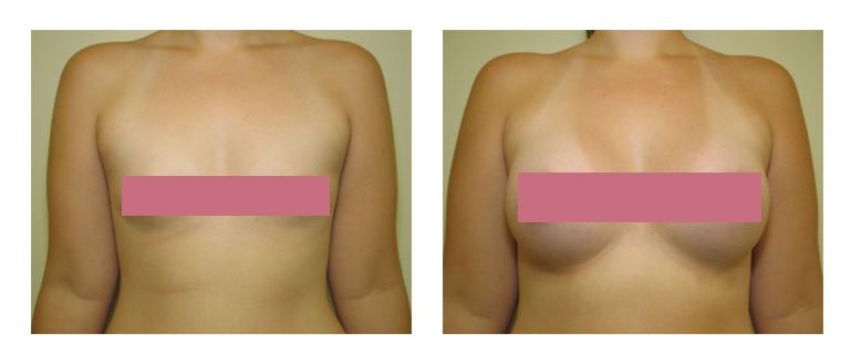 A Cup To D Cup Breast Augmentation? 